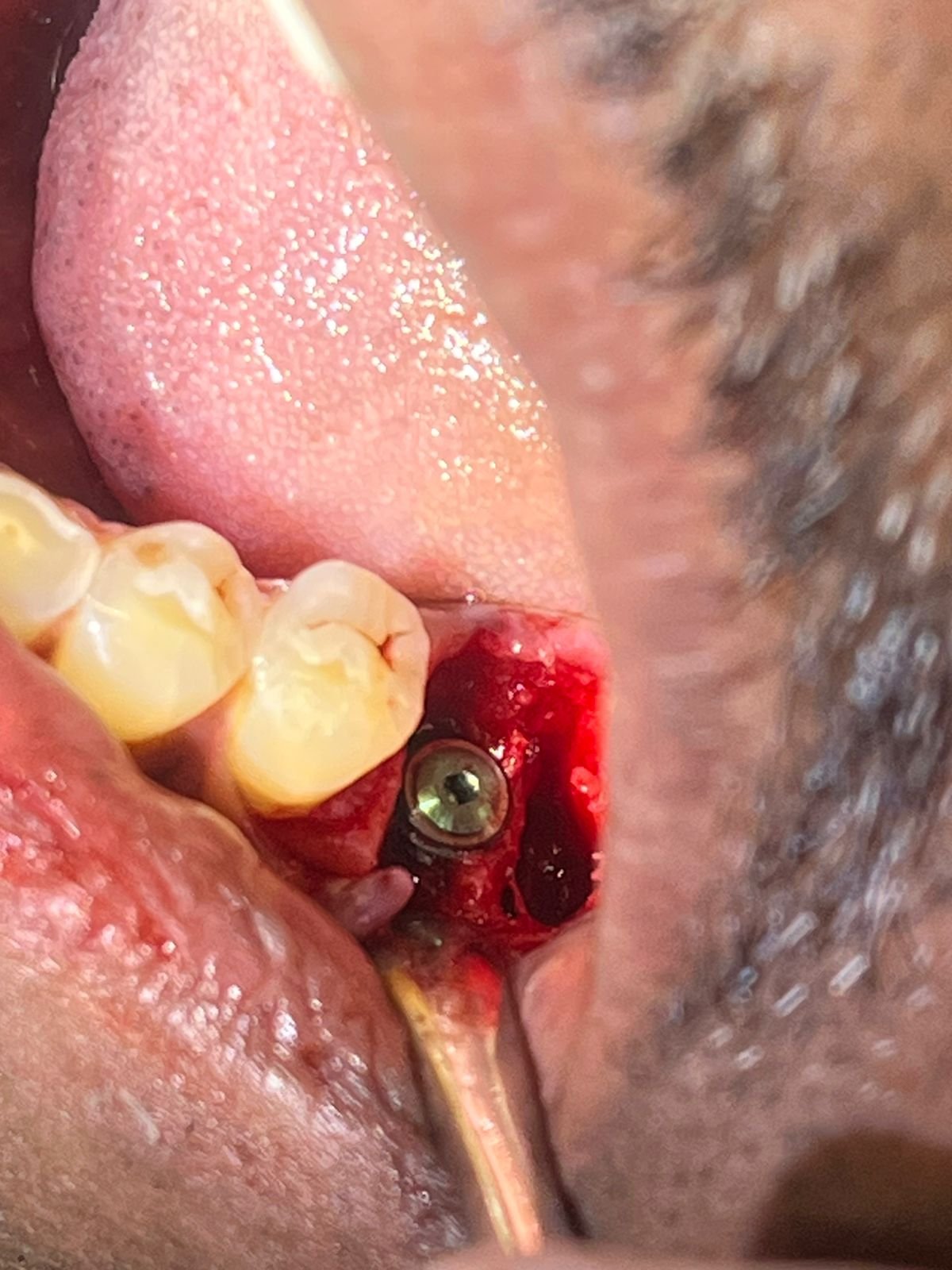 Dental Implants Greater Noida