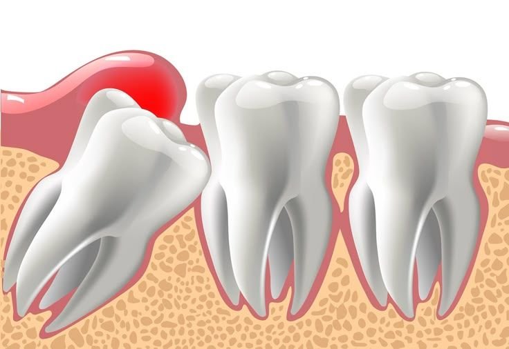 Impacted Teeth Extractions