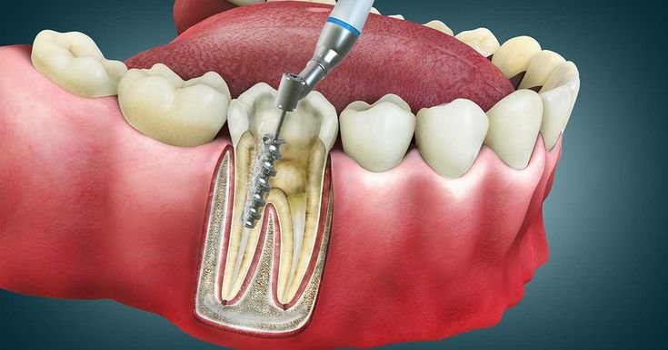 Root Canal Treatment